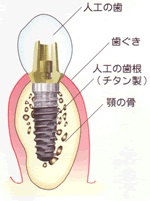 インプラントの構造